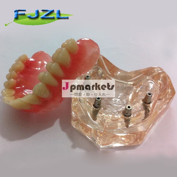 インプラントとインテリアoverdenture4/歯科インプラントのモデル/歯科教育のモデル問屋・仕入れ・卸・卸売り