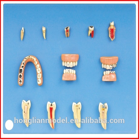 Gd/b10017歯科疾患モデル( の解剖学的モデル)-外科供給問屋・仕入れ・卸・卸売り