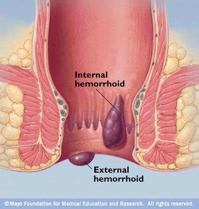 hemorrhoidectomyダイオードレーザー手術-レーザー外科及び療法装置問屋・仕入れ・卸・卸売り
